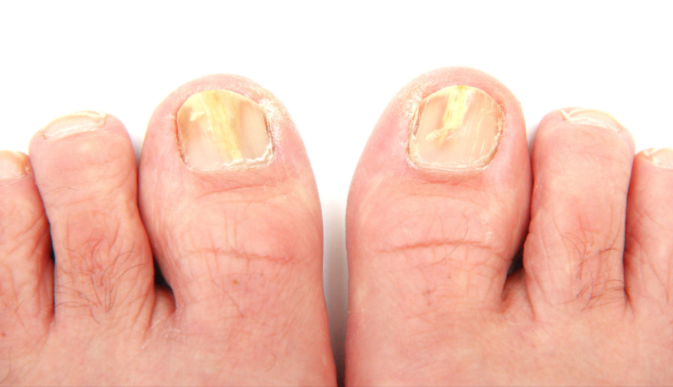 11 Natural Home Remedies To Treat & Get Rid Of Toenail Fungus